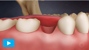 Oral Health Etobicoke - Dental Crowns Implants